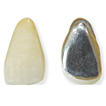 硬質レジン前装冠